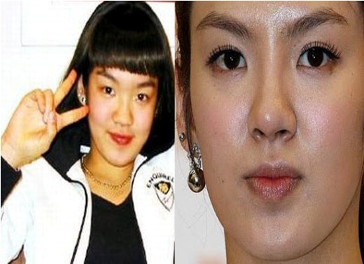 Hyoyeon SNSD Plastic Surgery Nose Job Hyoyeon SNSD Plastic Surgery Rumors