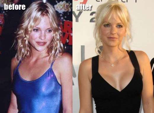 Anna Faris Plastic Surgery Anna Faris Plastic Surgery Before and After Pictures