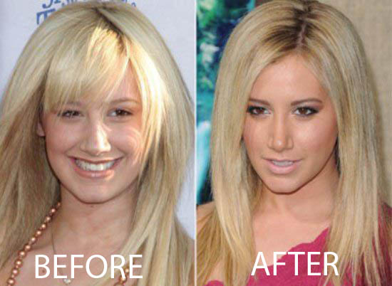 Ashley Tisdale Nose Job Ashley Tisdale Nose Job Before and After Pictures