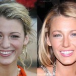Blake Lively Nose Job Before and After Pictures