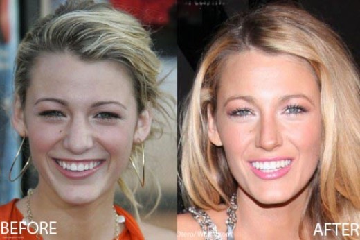 Blake Lively Nose Job Blake Lively Nose Job Before and After Pictures