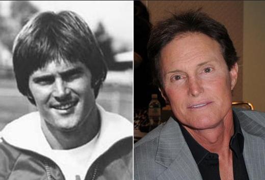 Bruce Jenner Plastic Surgery Before After Bruce Jenner Plastic Surgery   Facelift, Nose Job, Botox