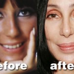 Cher Plastic Surgery Before and After Pictures