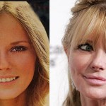 Cheryl Tiegs Plastic Surgery Before and After Pictures