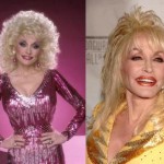 Dolly Parton Plastic Surgery Before and After