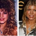 Fergie Plastic Surgery Before After