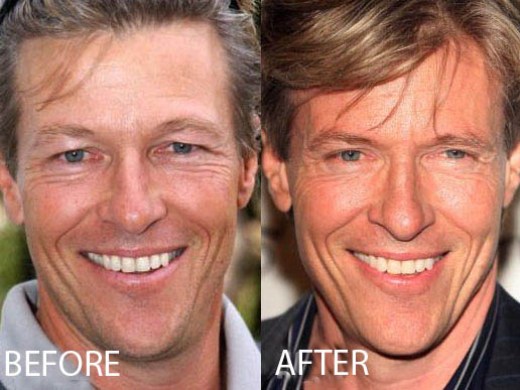 Jack Wagner Plastic Surgery Jack Wagner Plastic Surgery Before and After