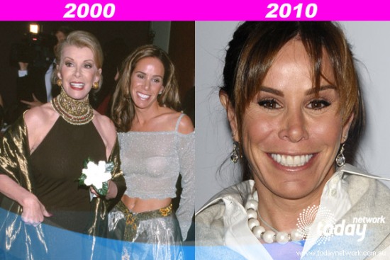 Melissa Rivers Plastic Surgery Before After