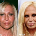 Donatella Versace Plastic Surgery Before and After