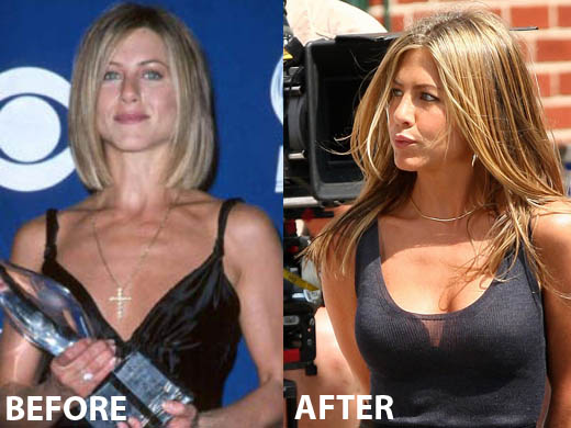 Jennifer Aniston Breast Implant Jennifer Aniston Breast Implant Before and After
