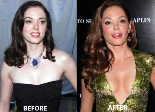 Rose Mcgowan Plastic Surgery Rose Mcgowan Plastic Surgery Before and After