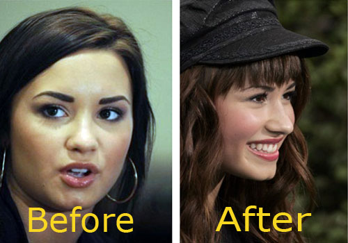Demi Lovato Plastic Surgery Before and After