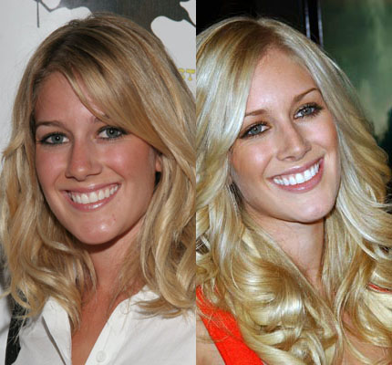 Heidi Montag Nose Job Before and After