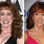 Kathy Griffin Plastic Surgery Before and After