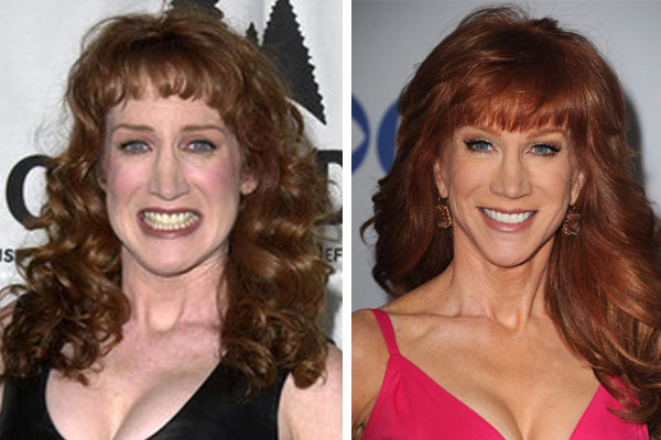 kathy griffin plastic surgery Kathy Griffin Plastic Surgery Before and After