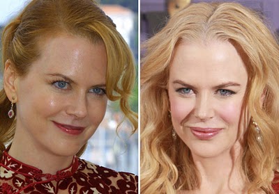 nicole kidman plastic surgery Nicole Kidman Plastic Surgery Before and After