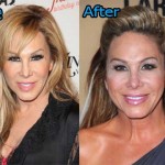 Adrienne Maloof Plastic Surgery Before After