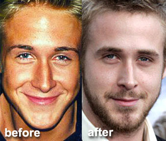 ryan gosling plastic surgery Ryan Gosling Plastic Surgery Before and After
