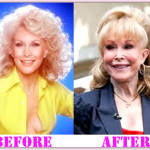 Barbara Eden Plastic Surgery Before and After