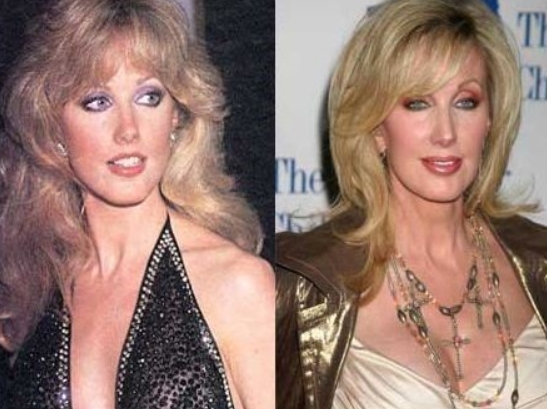 Morgan Fairchild Plastic Surgery Morgan Fairchild Plastic Surgery A